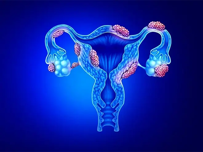 Endometrial Cancer
