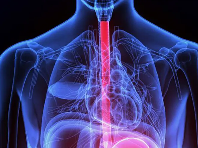 Esophageal Cancer