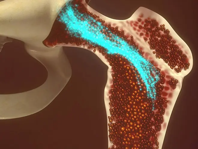 Multiple Myeloma