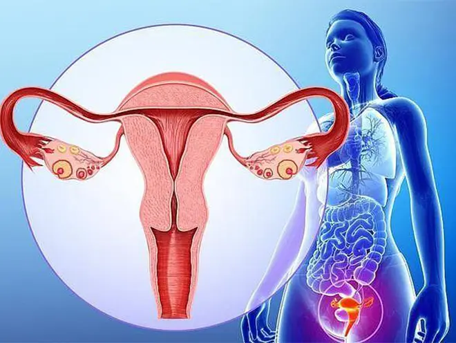 ovarian-cancer