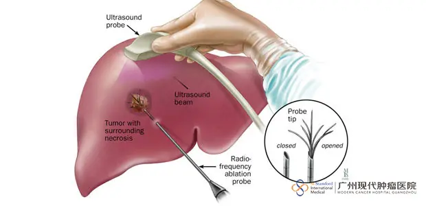 Radiofrequency Ablation