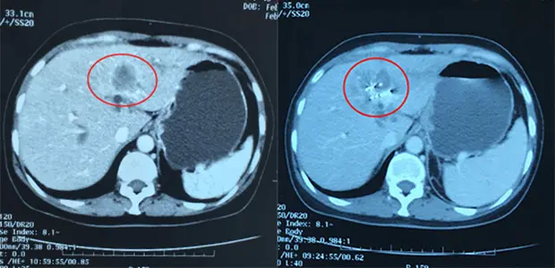Bile duct cancer with an intrahepatic bile duct tumor-03