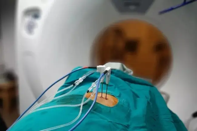 Microwave Ablation