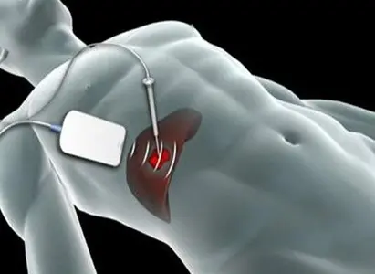 Microwave Ablation