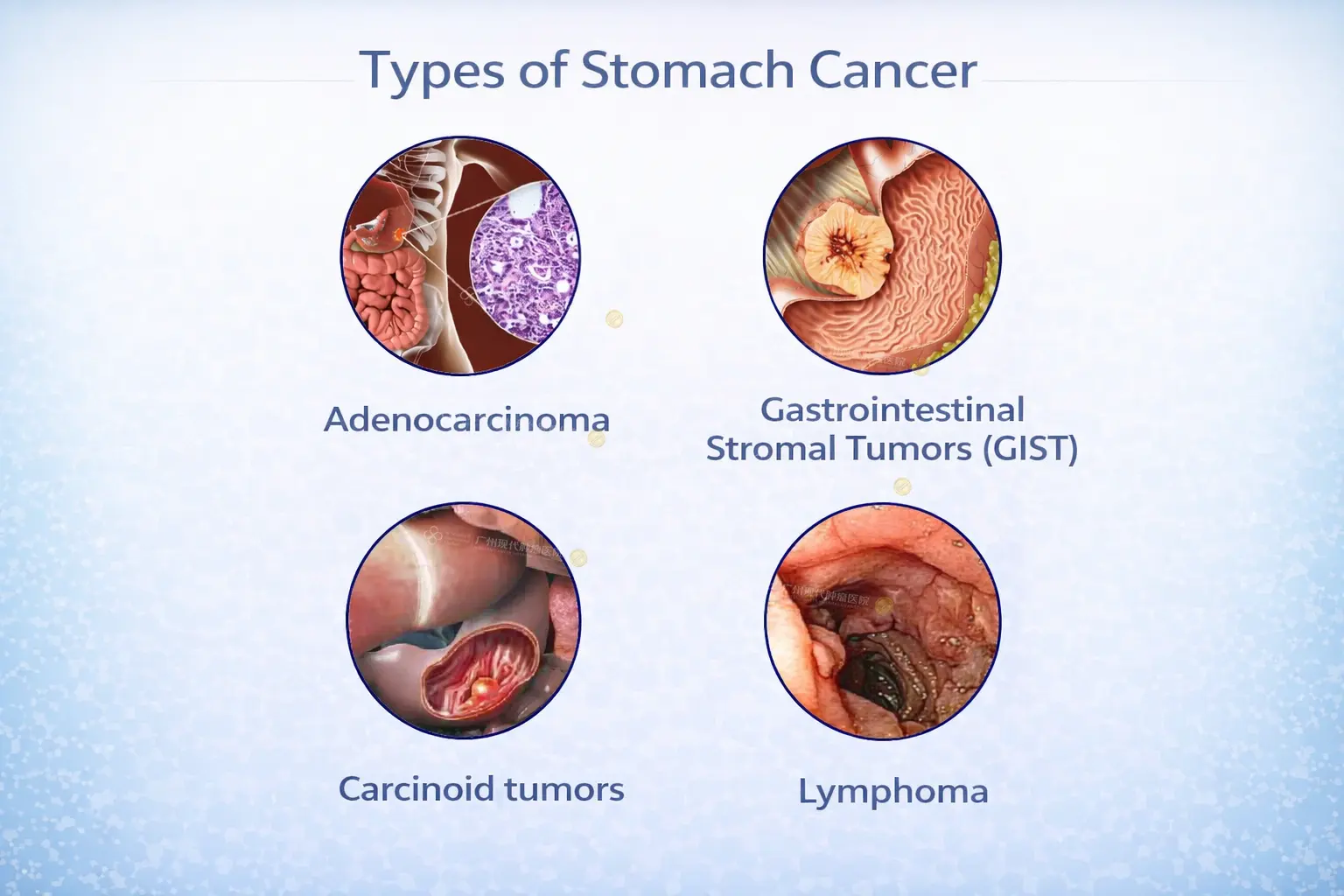 types-of-stomach-cancer